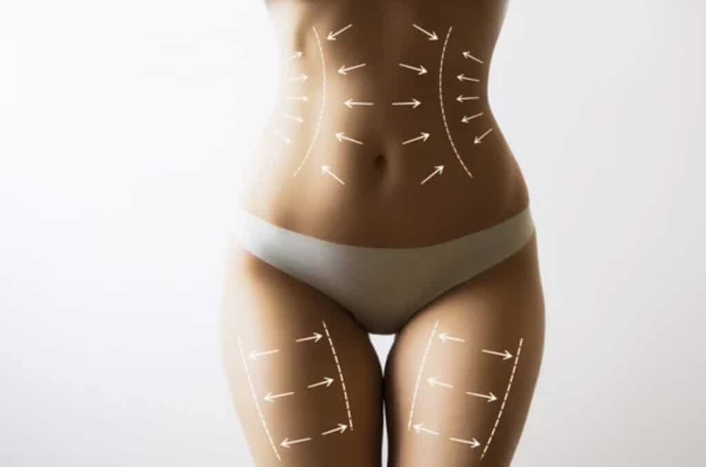 Liposuction